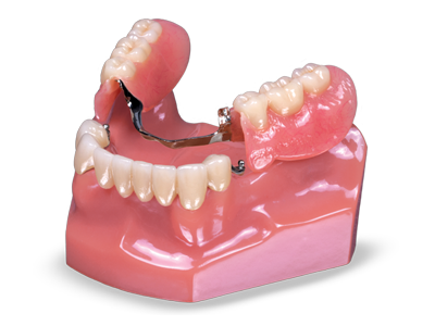 Combination Crowns and Partials